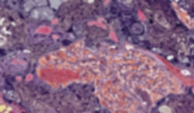 Rare Genetic Mutation Sheds Light on Alzheimer’s Disease 